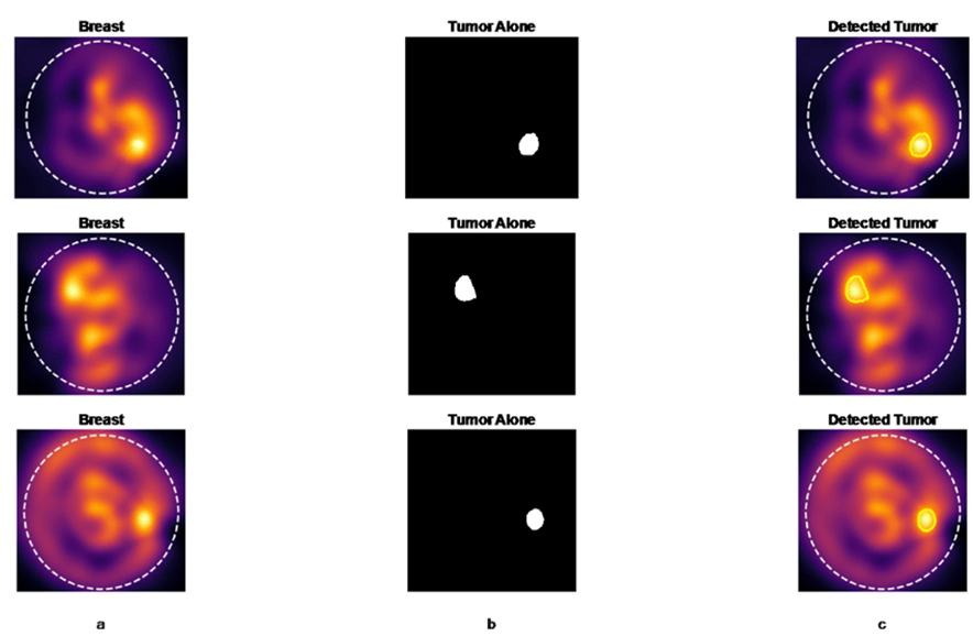 a) Source BMI; b) tumor; c) tumor region segmentation using the proposed method