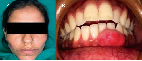 Extra oral photograph with no facial asymmetry (1A) and intraoral photograph of the growth (1B).