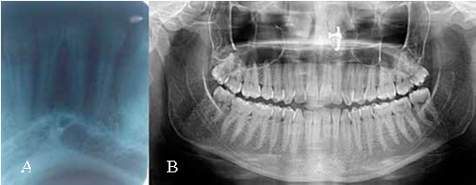 Intraoral periapical radiograph (2A) and Orthopantomograph (2B) of the lesion showing no apparent change in the bone.