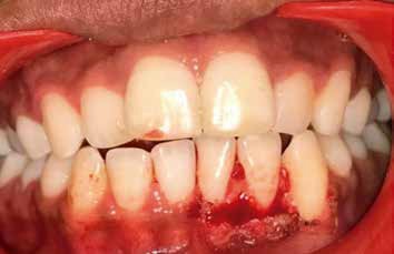 Intra oral photograph of the same region just after the excision of the lesion.