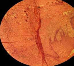 Photomicrograph of the lesion showing features of cemento-ossifying fibroma. (H & E, x10).