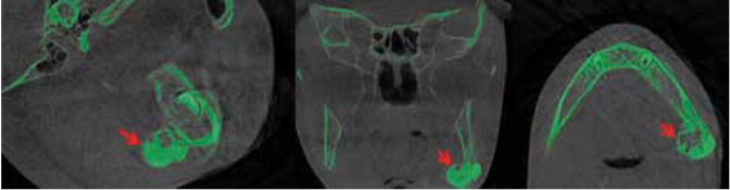 The pre-op CBCT showing radiopaque lesion on sagittal, coronal and axial plans.