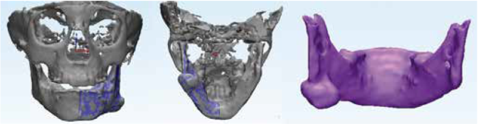 The 3D reconstruction of the osteoma attached on the left mandibular angle.