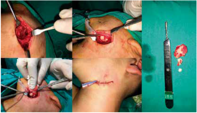 Intra operative photographs showing the excision of the osteoma and the specimen.