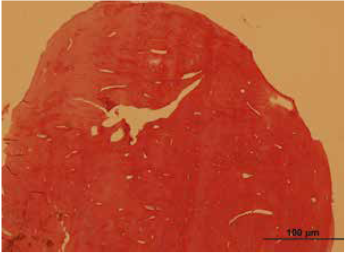 Low power microphotograph showing sclerotic lamellar bone nodule with almost no intertrabecular space. Hematoxylin & eosin x25.