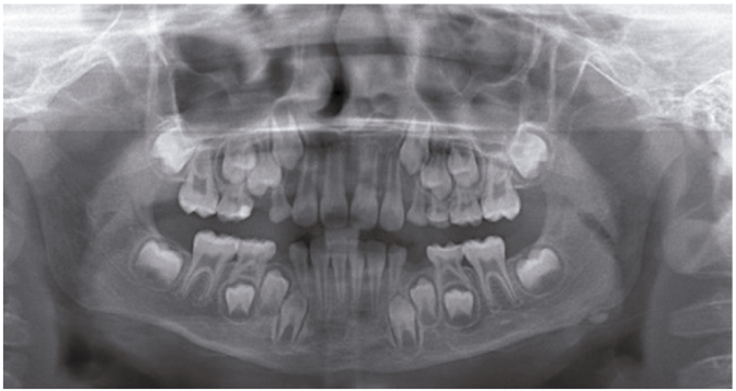 The post-op panoramic view (6 months after surgery).