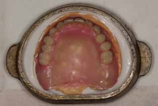 Flasking of the denture.