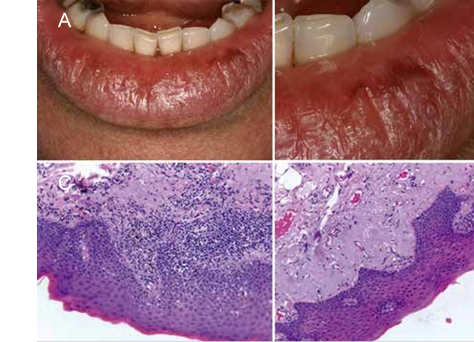 A. Queilitis actínica, se observa bermellón inferior con cambios generalizados: resequedad, fisuras, descamación y mácula melánica, B. Acercamiento. C. Epitelio escamoso sin cambios displásicos, en la capa basal hay leve hiperplasia de melanocitos, D. En la lámina propia hay extensa elastosis solar y melanófagos dispersos, algunos asociados a leve inflamación crónica (H&E 20X). 