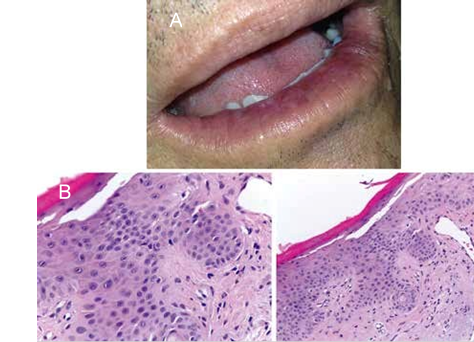 A. Bermellón inferior fisurado con aspecto levemente moteado: presencia áreas enrojecidos en medio de las placas y máculas blanquecinas y cafés. B. Hiperqueratosis con paraqueratosis, epitelio con cambios displásicos de grado moderado y C. En la lámina propia hay marcada elastosis solar (H&E 40X, 20X).