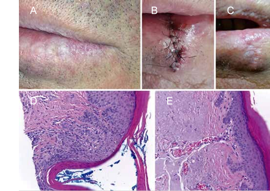A. Control clínico a los 4 años, donde se observa bermellón inferior muy reseco con área tipo placa, blanca e indurada con pérdida de línea divisoria del bermellón con piel, B. Biopsia de la lesión. C. Control clínico a los dos meses. D. Hiperqueratosis con paraqueratosis, y ortoqueratosis, zonas de hiperplasia y atrofia, displasia leve. E. En la lámina propia hay marcada elastosis solar y vasos sanguíneos talangectásicos (H&E 20X).