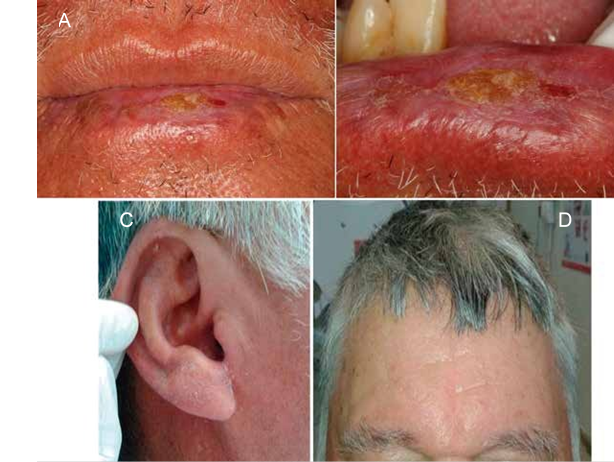 A y B. Bermellón de labio inferior reseco con alteración de la línea de transición cutánea, edema, áreas eritematosas, úlceras y costras, fisuras, adelgazamiento del bermellón y zonas leucoplásicas, C y D. Piel expuesta al sol se observó reseca y con lesiones descamativas, tipo queratosis actínica