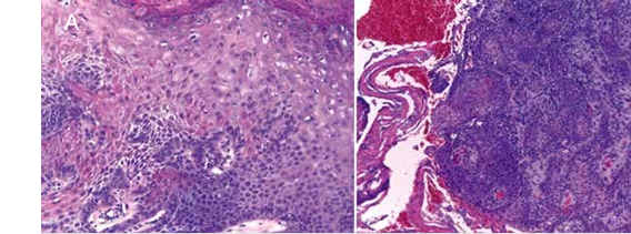 A. Queilitis actínica con displasis leve: Hiperqueratosis con paraqueratosis, hipergranulosis y cambios de displasis leve (H&E 20X). B. Carcinoma de células escamosas muy bien diferenciado (H&E 10X). 