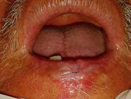 Control clínico a los veintidós días de la biopsia.