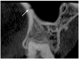 Identificación de la Arteria Alveolar Superior Posterior en un corte tomográfico