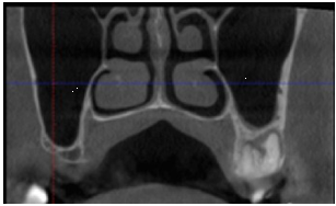 Contorno de senos maxilares mostrados por tomografía computadorizada