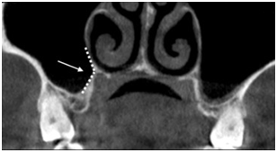 Ángulo del Proceso Nasopalatino obtuso asociado con un menor riesgo de perforación de membrana de Schneider