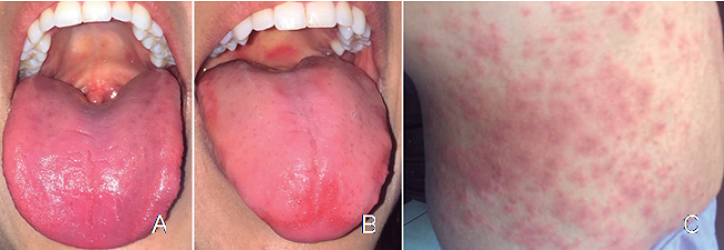 A. Dorso de lengua libre de ulceraciones, pero con textura levemente lisa y brillante, asintom&aacute;tica al mes de tratamiento. B. Dorso de lengua menos brillante, pero con parches irregulares eritematosos posteriores a la ingesta de trigo. C. Piel del troco en el cuerpo de la paciente posterior a la ingesta de trigo.