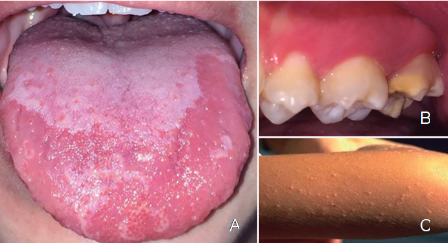  A. Dorso de lengua con &aacute;reas depapiladas y eritematosas en combinaci&oacute;n con placa central saburral. B. Hipoplasia del esmalte en segundo molar superior izquierda. C. Rash sin prurito en brazo.