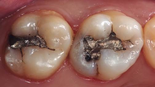 Restauraciones de amalgama con corrosión, pérdida de morfología y microfiltraciones.