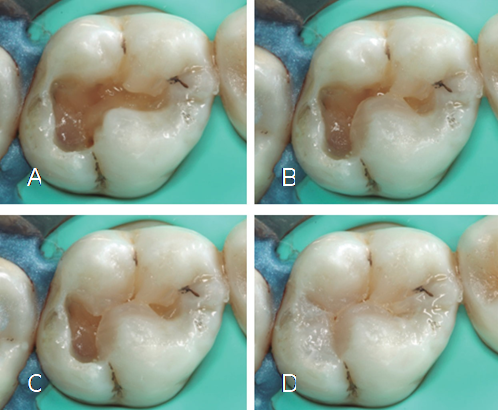 Secuencia de trabajo para reconstrucción de esmalte utilizando resinas para estratificación de alto índice de refracción (UE1, ENA Hri, Micerium SPA).