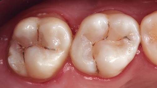 Control inmediato de las restauraciones.