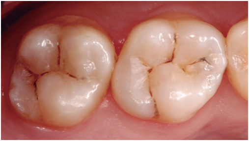 Control de 18 meses.