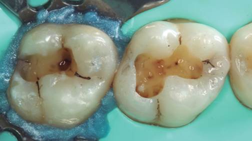 Bajo aislamiento absoluto, se realizó la eliminación de las restauraciones defectuosas.