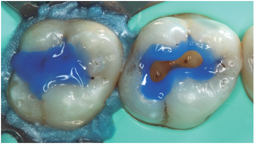 Aplicación de ácido fosfórico para las técnicas adhesivas.