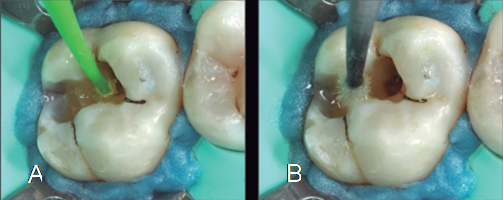 A) Diente 1.7, Aplicación de primer de Optibond FL (Kerr). B) Aplicación de bonding posterior a la aplicación del primer.