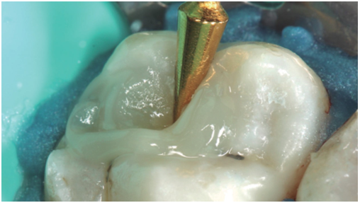 Diente 1.7, con aplicación de resina Bullk-Fill compactable en incremento único. Se utilizó un instrumental para resina conoide, que permite mejor adaptación y eliminación de excesos en el borde cavosuperficial, así como también el tallado de la restauración.