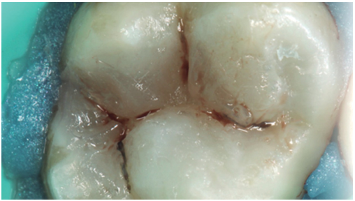 Aplicación de tintes en los surcos principales para caracterización y sensación de profundidad de los surcos. La eliminación de excedentes fue realizada con microbrush.