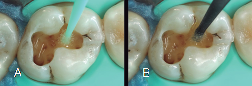 Técnica adhesiva en diente 1.6. A) Aplicación de primer acídico de ClearFill SE (Kuraray), seguido de B) la aplicación de bonding de bajo relleno del mismo producto.