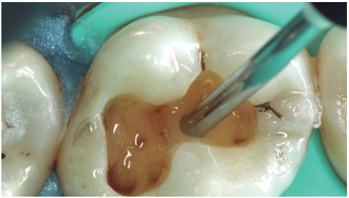 Una vez realizada la técnica adhesiva, se regulariza el piso cavitario con una resina Bulk-fill fluida (Surefil SDR flow, DENTSPLY).