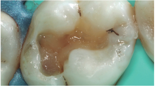 Incorporación de resina Bulk-fill compactable (Filtek Bulk Fill Posterior, 3MEspe) para reemplazar el espacio dentinario perdido. Nótese que hay espacio suficiente para la carga final de esmalte, así como también existe delimitación de las cúspides a través de la conformación de surcos internos.
