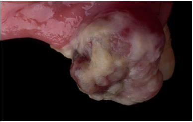 Aumento de volumen de aspecto granulomatoso lobulado eritematoso con placas blanquecinas, sangrante a la manipulaci&oacute;n asociado a la regi&oacute;n de enc&iacute;a insertada entre &oacute;rganos dentarios 23 y 24.