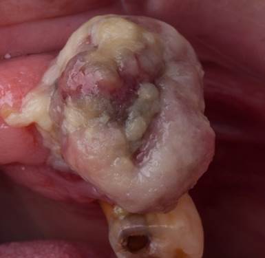 Vista oclusal de aumento de volumen de aspecto granulomatoso lobulado eritematoso con placas blanquecinas, &aacute;rea de ulcera central en proceso reparativo.