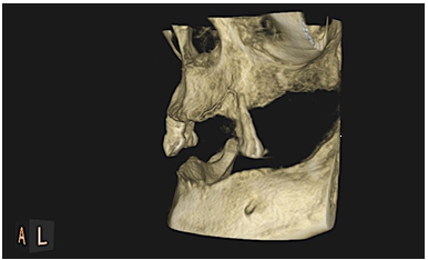 Cone beam reconstrucci&oacute;n 3D, se observa una area isodensa con actividad l&iacute;tica en regi&oacute;n de organos dentarios 23 y 24.