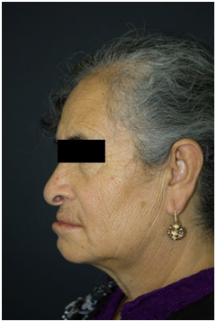 Fotograf&iacute;a cl&iacute;nica lateral izquierda exploraci&oacute;n extra oral.