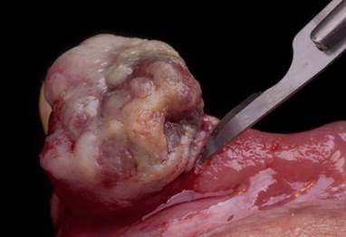 dise&ntilde;o de colgajo mucoperi&oacute;stico en sobre con liberatr&iacute;z, disecci&oacute;n roma de la lesi&oacute;n hasta periostio.