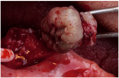 Lecho quir&uacute;rgico con sangrado profuso, controlado con cera para hueso y sutura.