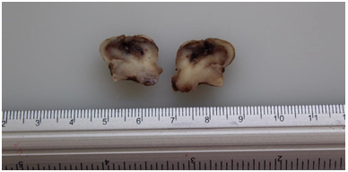 Macroscop&iacute;a de muestra biol&oacute;gica corte longuitudinal, forma oval irregular de superficie lobular de color caf&eacute; claro y &aacute;reas oscuras y de consistencia dura que en su totalidad mide 2.0x1.5x1.6 cm.