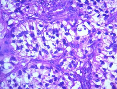 Fotomicrograf&iacute;a a 40x, c&eacute;lulas claras dispuestas en nidos solidos con bordes n&iacute;tidos, citoplasma eosin&oacute;filo con marcado pleomorfismo celular y nuclear, nucl&eacute;olos evidentes y mitosis at&iacute;picas, dispuestas sobre un estroma de tejido conjuntivo laxo dispuesto de manera desorganizada y el epitelio bucal de cubierta con acantosis y cambios displ&aacute;sicos.