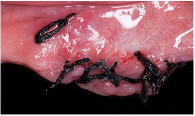 Fotograf&iacute;a cl&iacute;nica de post operatorio inmediato a los 8 d&iacute;as con datos de herida limpia en proceso de reparaci&oacute;n tisular.