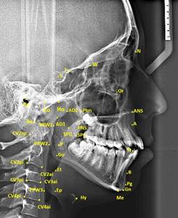 Cephalometric landmarks used in study. (S: It is the geometric center point of Sella tursica; N: It is the most advanced point in the middle oxal plane, where the nasofrontal suture intersects the sagittal plane, and the deepest point of the recess in that area; Ptm: It is the lowest point of the fissure formed by the retromolar tubercle of maxillary and the pterygoid part of the sphenoid bone; PNS: It is the most posterior and end point of the hard palate in the sagittal plane; A: It is the deepest point of concave located between the anterior nasal spina and prosthion; Pg: It is the most advanced point of the mandibular symphysis in the sagittal plane; Ba: The junction between the base of the cranium and the outer edge of the clivus cranium and the endocranium edge; Hy: Hyoid is the top and anterior point of the bone corpus; P: It is the extreme point of the soft palate; Ep: The Epiglottis base is also the most posteroinferior point in the tongue base; Et: It is the end point of the epiglottis; Ho: It is the point at the intersection between the perpendicular line drawn from PNS to the Sella-Basion and the cranial base; AD1: It is the point where the line connecting the PNS and the Basion intersect the posterior of the nasopharyngeal wall; AD2: It is the point at the intersection of the line drawn from the PNS to the midpoint of the line connecting the Sella-Basion and the posterior of the nasopharyngeal wall.)