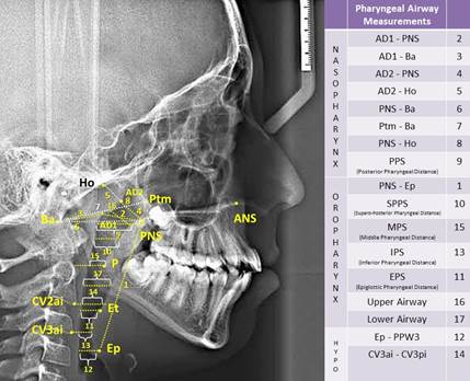 Pharyngeal airway measurements used in study. (PPS: palatal pharyngeal distance: on the line passing from PNS, parallel to FH. SPSS, superior posterior pharyngeal distance: on the line passing from the midpoint of the soft palate, parallel to FH. MPS, middle pharyngeal distance: on the line passing from P, parallel to FH. IPS, inferior pharyngeal distance: on the line passing from cv2a, parallel to FH. EPS, epiglottic pharyngeal distance: on the line passing from E, parallel to FH.)