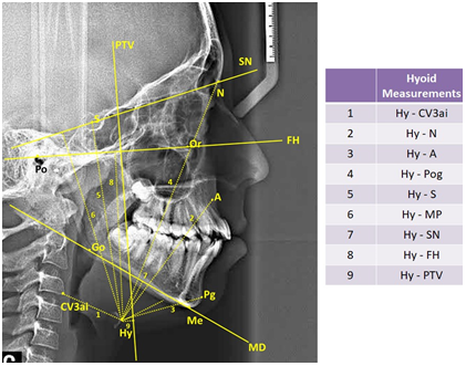 Hyoid measurements used in study.