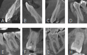 Calcificaciones en diferentes cortes TCHC (A) incisivo central superior, (B) incisivo lateral inferior, (C) canino superior, (D) premolar inferior, (E) primera molar inferior, (G) segunda molar inferior, (H) tercera molar superior en vistas sagitales y (F) primera molar superior en corte coronal.