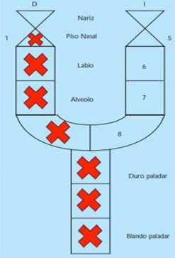Kernahan scheme of the patient. Unilateral Palatal Lip Fissure (Right).