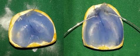 Shutter acrylation and Placement of the 0.8 mm orthodontic wire folds on each side and add a little more acrylic with the drip technique, in order to hold them.