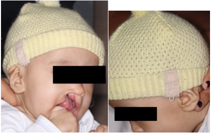 Modified hat with brooches.